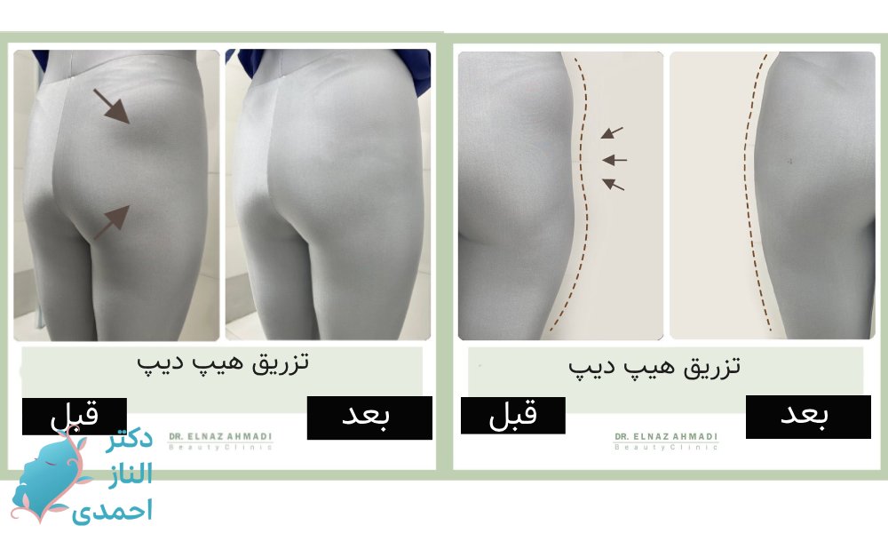تزریق هیپ دیپ