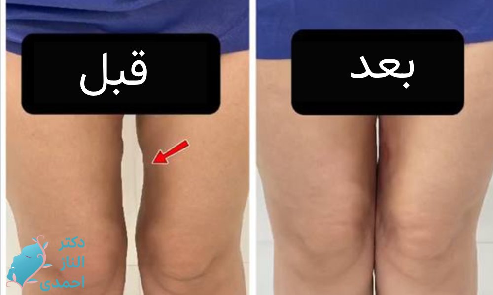 فیلر ران ها 