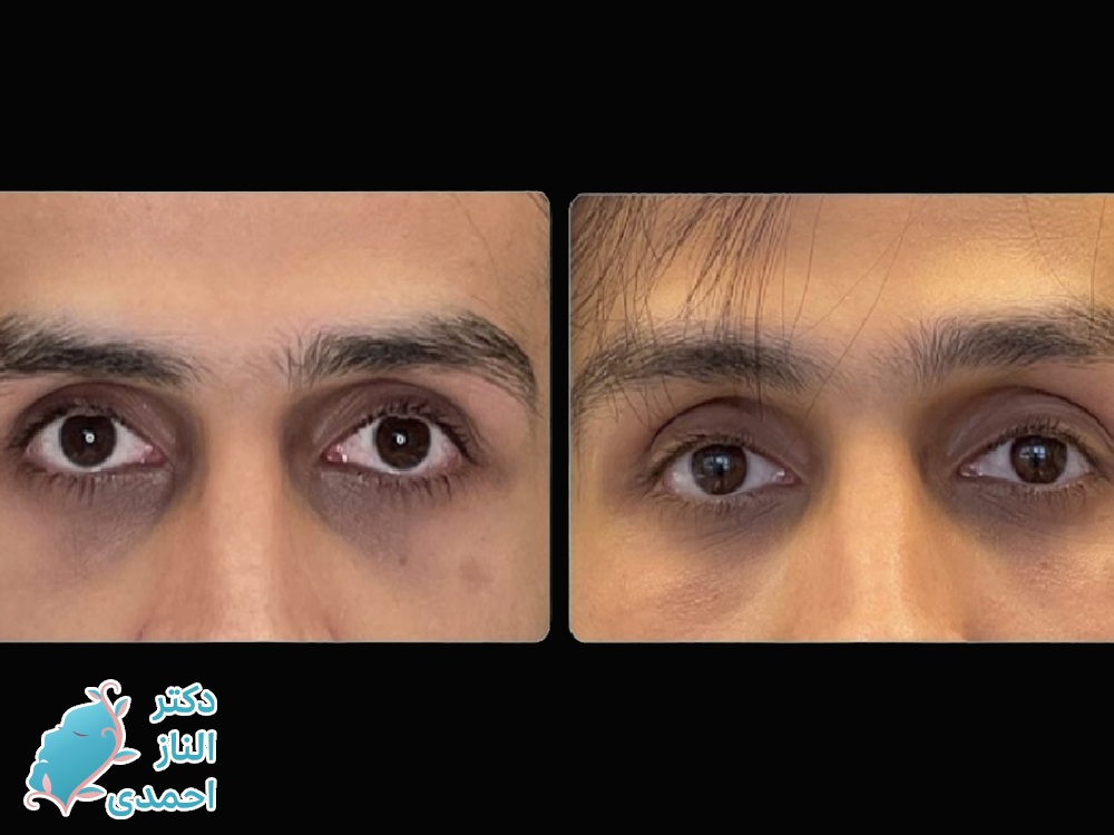 فیلر زیرچشم-قبل و بعد-کلینیک دکتر الناز احمدی