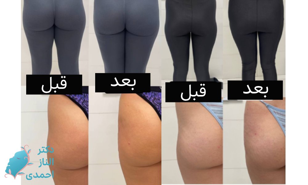 کاربرد فیلر بادی
