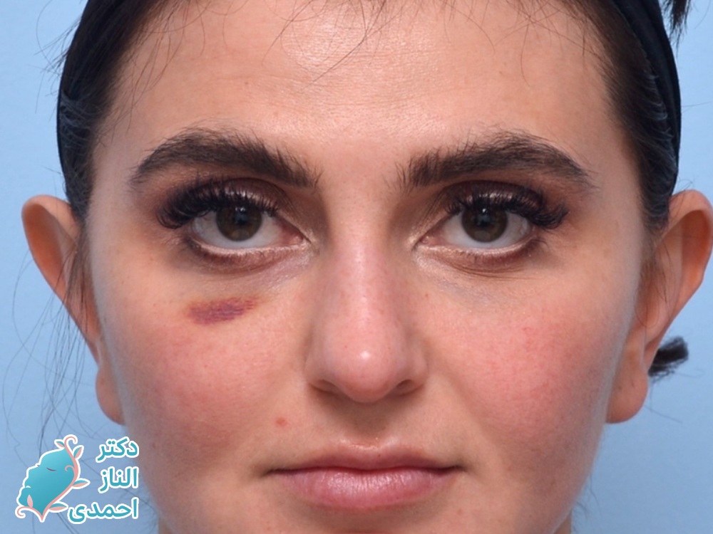 کبودی و ورم از عوارض زیر چشم