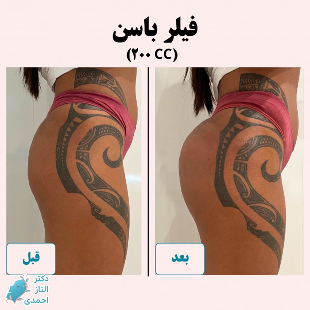 تزریق فیلر به باسن