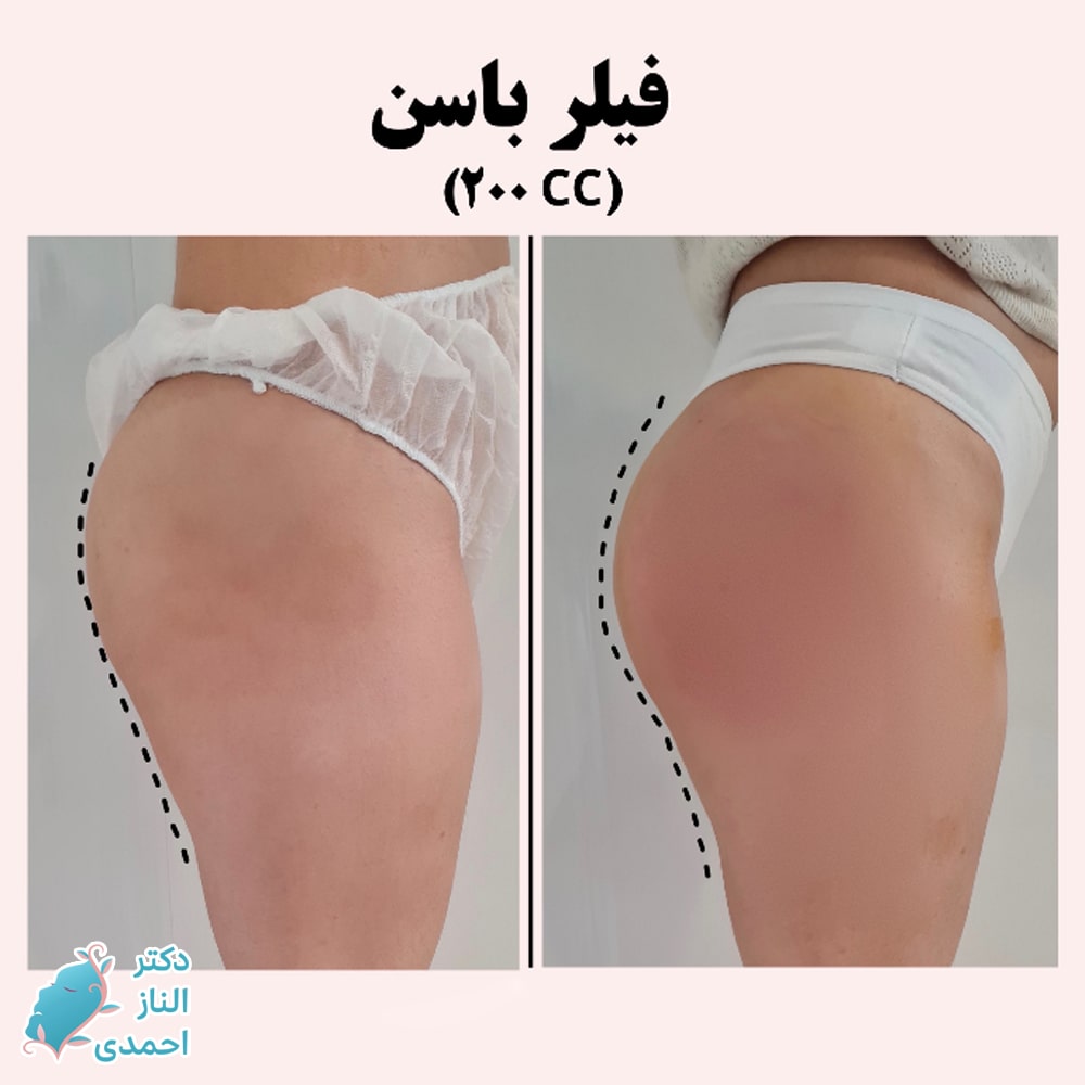 تزریق فیلر به باسن