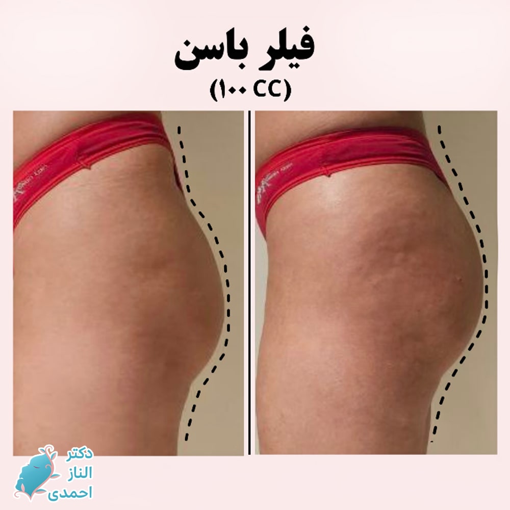 تزریق فیلر به باسن