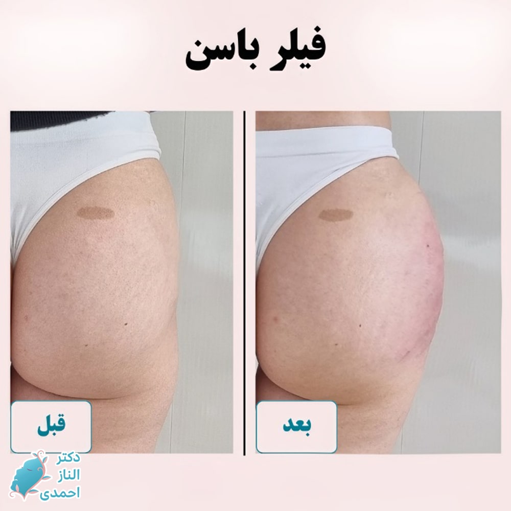 تزریق فیلر