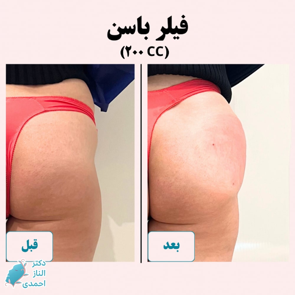 تزریق فیلر