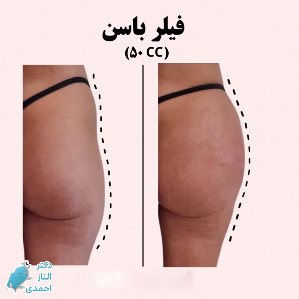 تزریق فیلر
