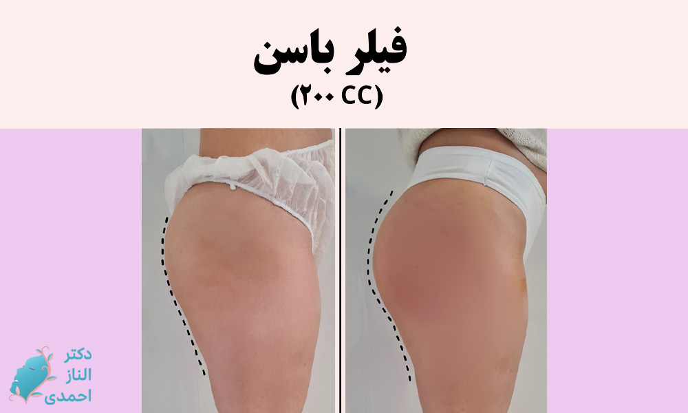 تزریق فیلر