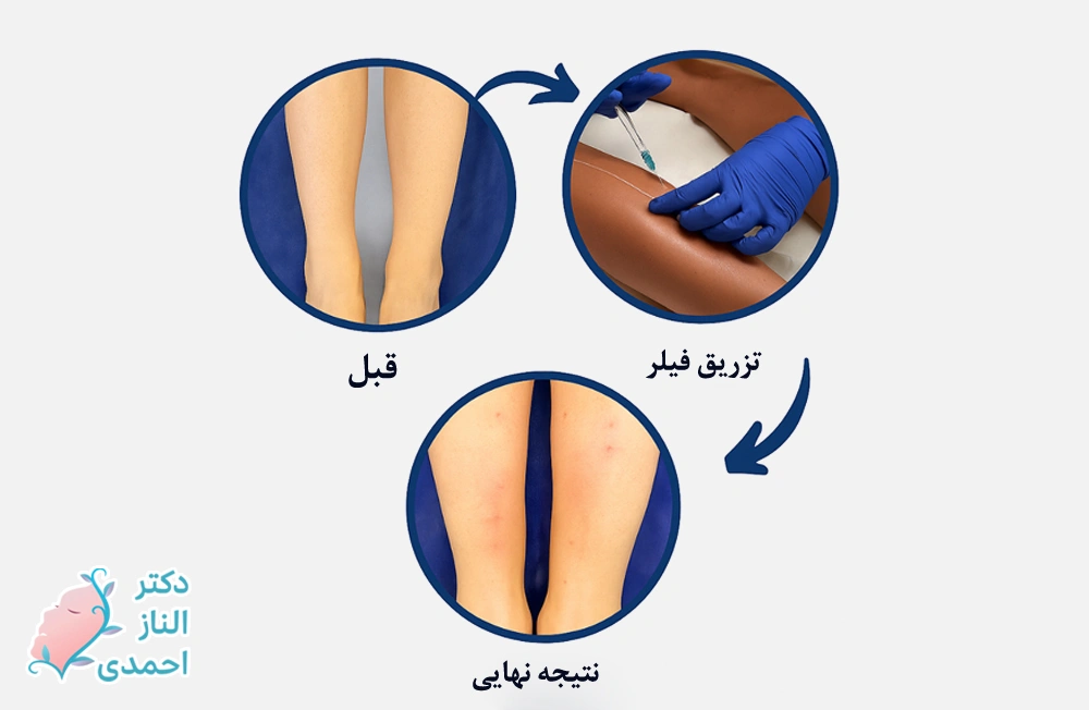 فیلر ساق پا