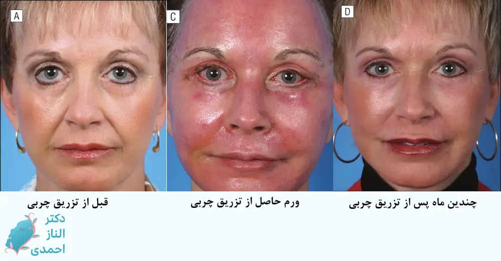 ورم بعد از تزریق چربی