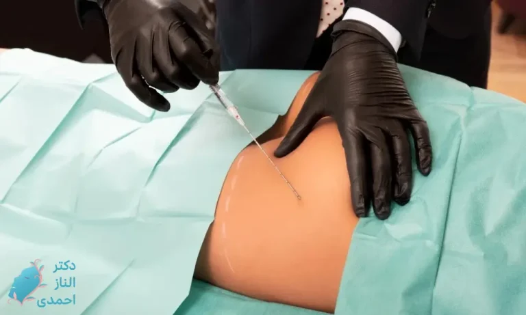 تزریق چربی به باسن