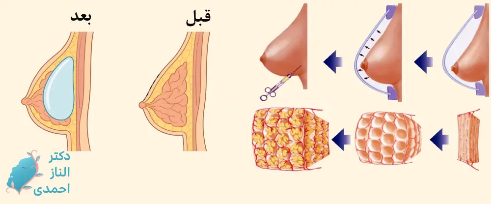 فرایند تزریق ژل به سینه 