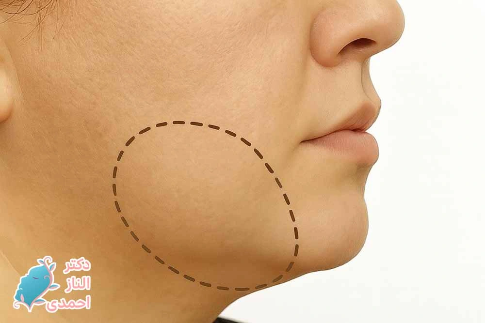 تجمع چربی تجمع چربی