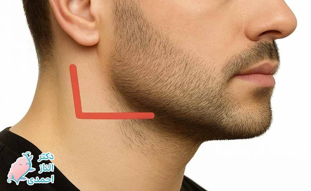 زاویه سازی فک مخصوص آقایان
