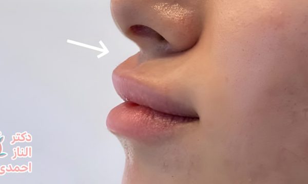لب اردکی؛ عارضه بعد از تزریق ژل یا مدل فیلر لب
