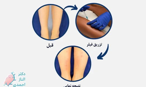 فیلر ساق پا