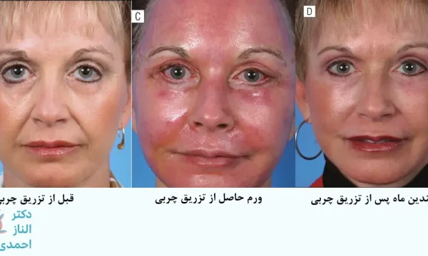 ورم بعد از تزریق چربی