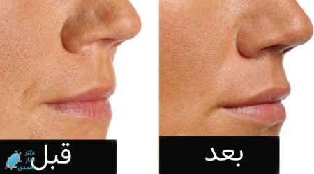 تزریق ژل لب طبیعی(فیلر لب نچرال)،حجم و قیمت